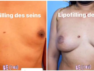 Lipofilling avant et après - 850923