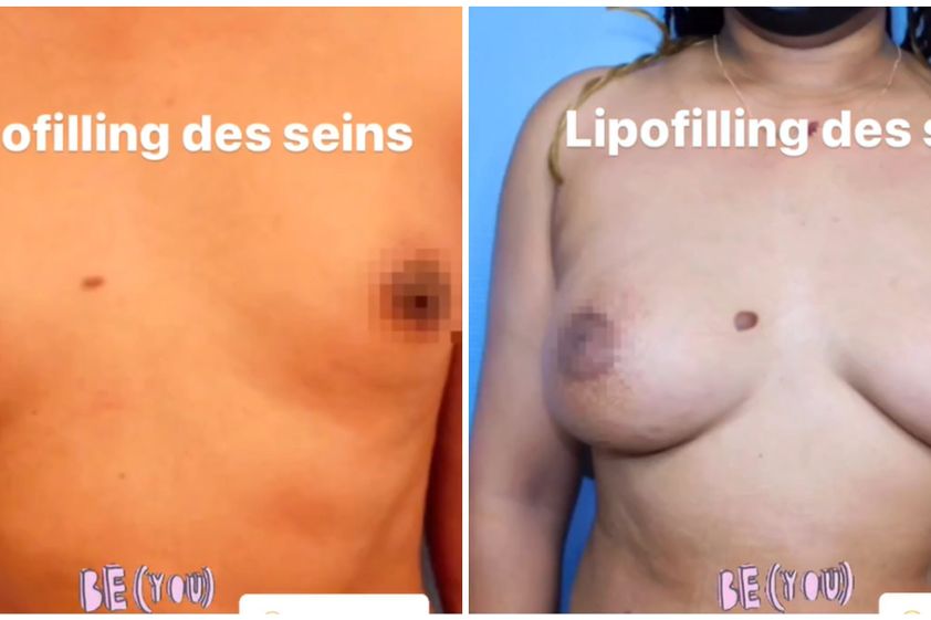 Lipofilling avant et après - 850923