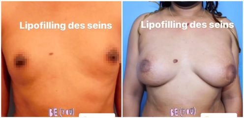 Lipofilling des seins - Dr Juan Carlos Rivera