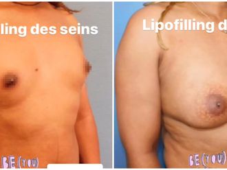 Lipofilling avant et après - 850924