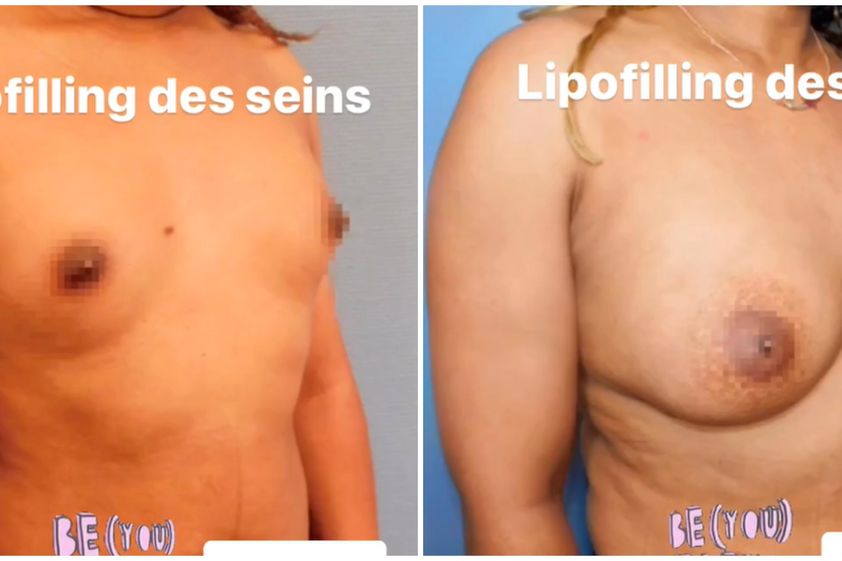 Lipofilling avant et après - 850924