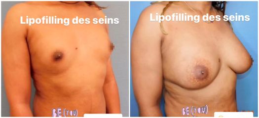 Lipofilling des seins - Dr Juan Carlos Rivera