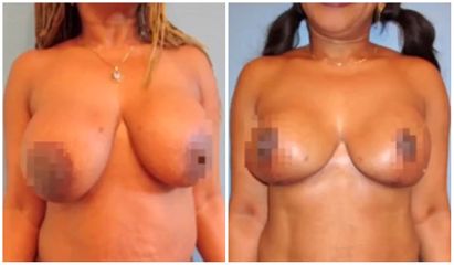 Mastopexie - Dr Juan Carlos Rivera
