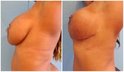 Mastopexie - Dr Juan Carlos Rivera