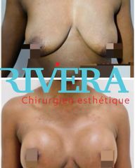 Augmentation mammaire - Dr Juan Carlos Rivera