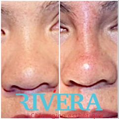 Rhinoplastie - Dr Juan Carlos Rivera