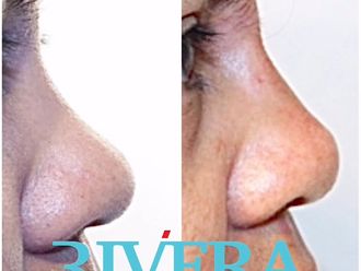 Rhinoplastie avant et après - 870226