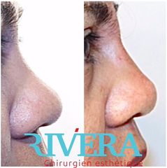 Rhinoplastie - Dr Juan Carlos Rivera