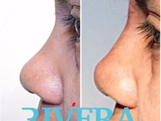 Rhinoplastie avant et après - 870227