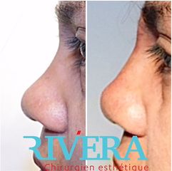 Rhinoplastie - Dr Juan Carlos Rivera