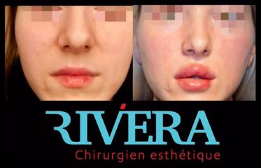 Rhinoplastie - Dr Juan Carlos Rivera