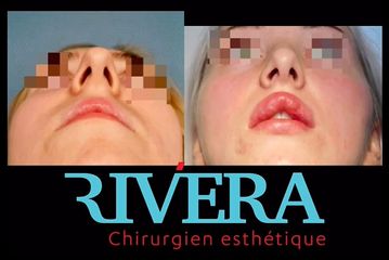 Rhinoplastie - Dr Juan Carlos Rivera