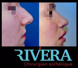 Rhinoplastie - Dr Juan Carlos Rivera