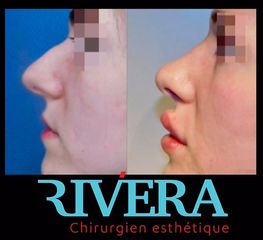 Rhinoplastie - Dr Juan Carlos Rivera