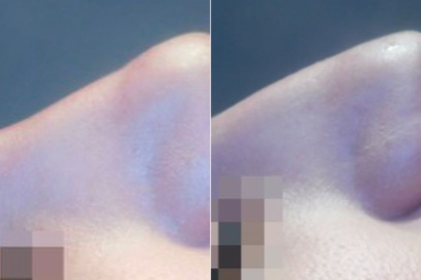 Rhinoplastie médicale avant et après - 872815