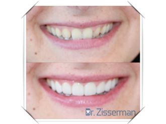 Implants dentaires - 557401
