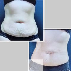 Cryolipolyse ventre - Dr Marie Levisse - méDiKal esthétique