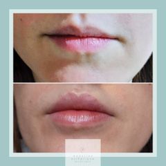 Augmentation des lèvres - Dr Marie Levisse - méDiKal esthétique