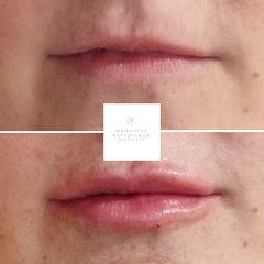 Augmentation des lèvres - Dr Marie Levisse - méDiKal esthétique