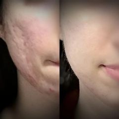 Traitement anti-acné - Dr Marie Levisse - méDiKal esthétique