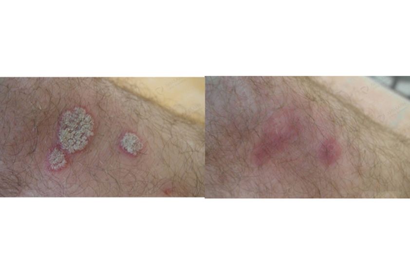 Psoriasis avant et après - 548990