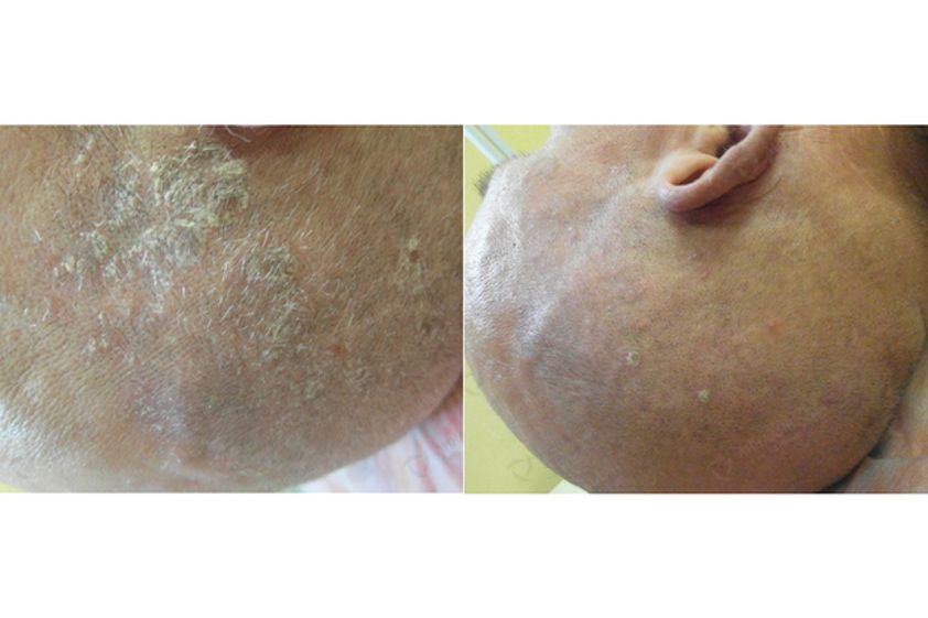 Psoriasis avant et après - 548991