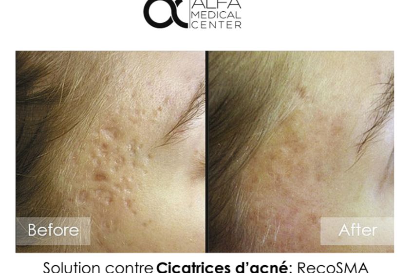 Traitement cicatrice avant et après - 632955