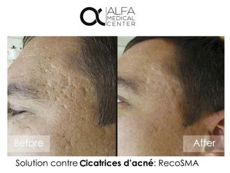 Traitement cicatrice - 632956