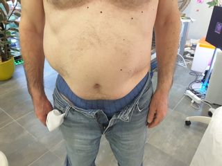 Cryolipolyse 