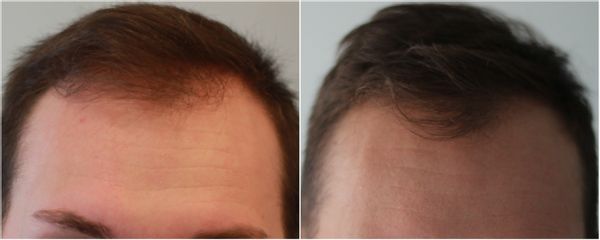 Greffe de cheveux - Dr Alain Berkovits