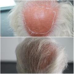 Greffe de cheveux - Dr Alain Berkovits