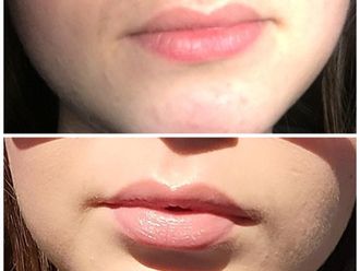 Augmentation des lèvres - 862667