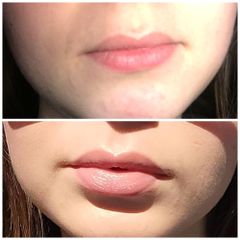 Augmentation des lèvres - Dr Alain Berkovits