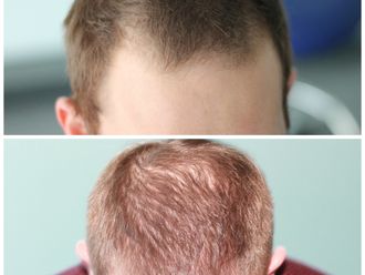Greffe de cheveux - 862748