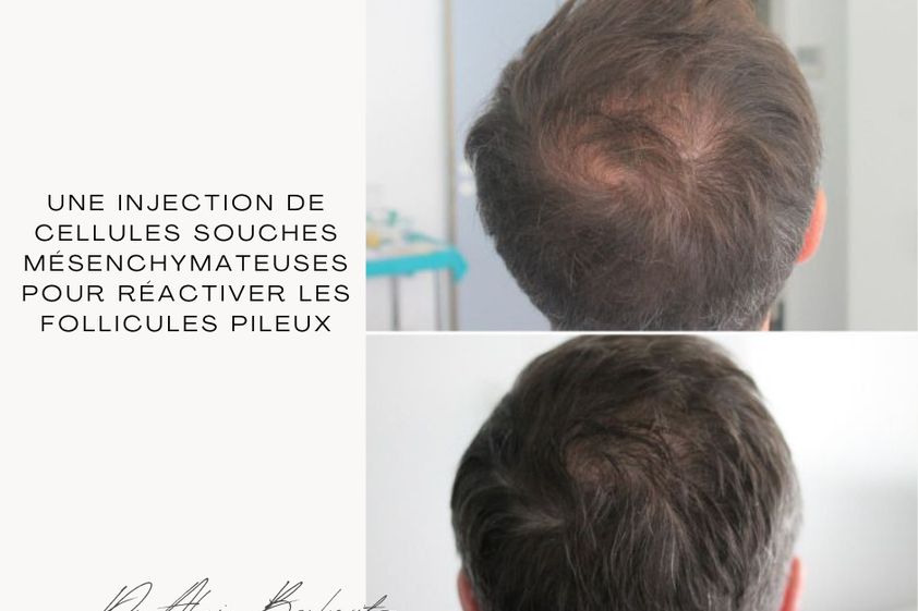 Mésothérapie avant et après - 871206