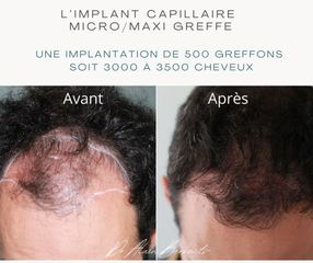 Implants capillaires - Dr Alain Berkovits