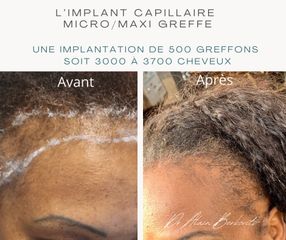 Implants capillaires - Dr Alain Berkovits