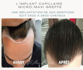 Implants capillaires - Dr Alain Berkovits