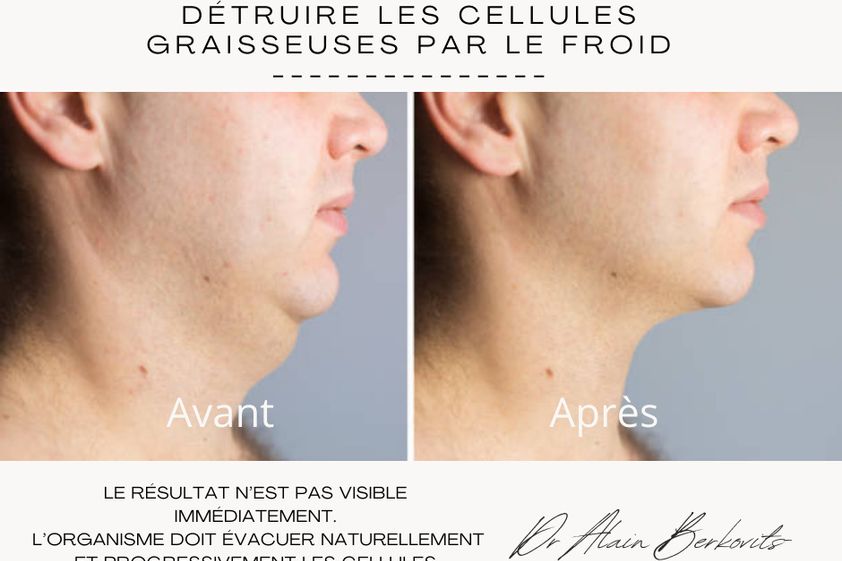 Cryolipolyse avant et après - 871219