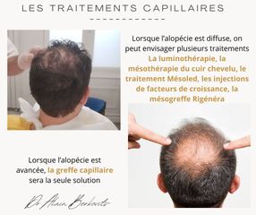 Traitement capillaire - Dr Alain Berkovits