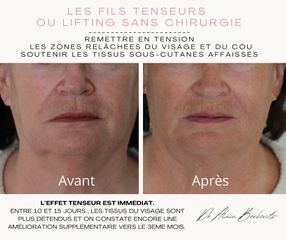 Fils tenseurs - Dr Alain Berkovits