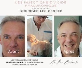 Acide Hyaluronique - Dr Alain Berkovits