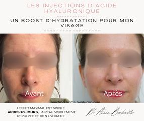 Acide hyaluronique - Dr Alain Berkovits