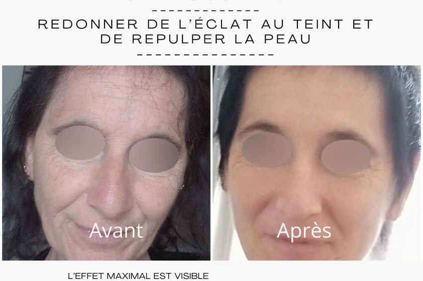 Mésothérapie avant et après - 871253