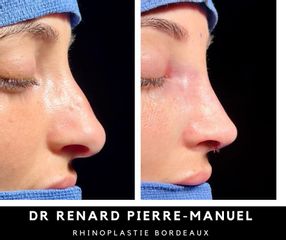 Rhinoplastie - Dr Pierre-Manuel Renard