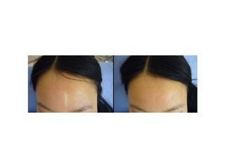 Avant après Dermopigmentation
