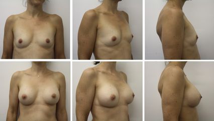 Augmentation mammaire - Dr Mathieu Piquet