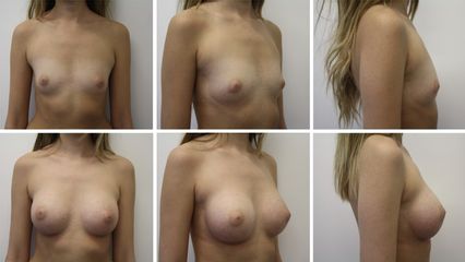 Augmentation mammaire - Dr Mathieu Piquet