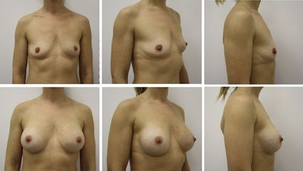 Augmentation mammaire - Dr Mathieu Piquet