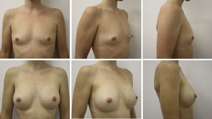 Augmentation mammaire - Dr Mathieu Piquet